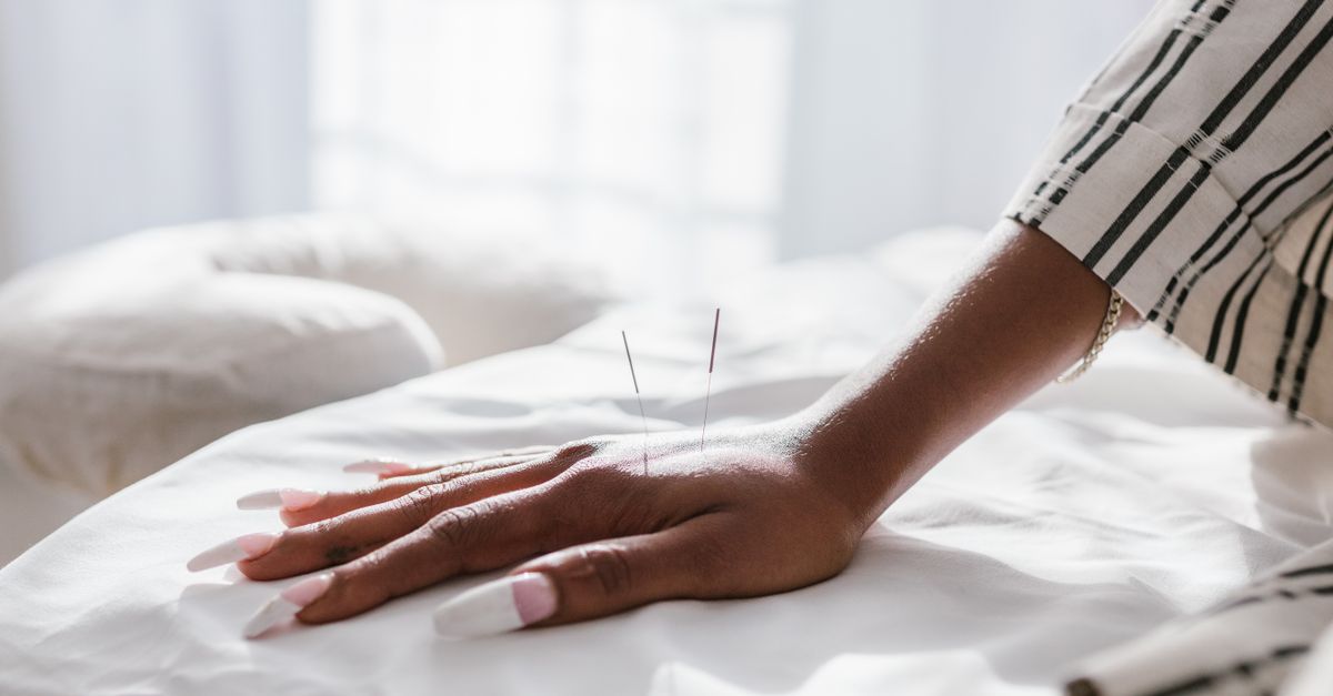 Close-up of a hand receiving acupuncture for holistic wellness in a spa setting.